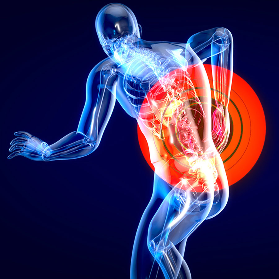 fibromyalgia